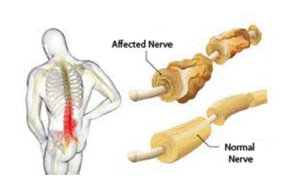 Guillain-Barré Syndrome (GBS) | UPSC Compass